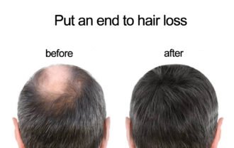 ANTI HAIR LOSS 1